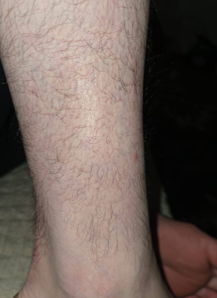 Псориаз голеностопного сустава после лечения LL COMPLEX — восстановленная кожа