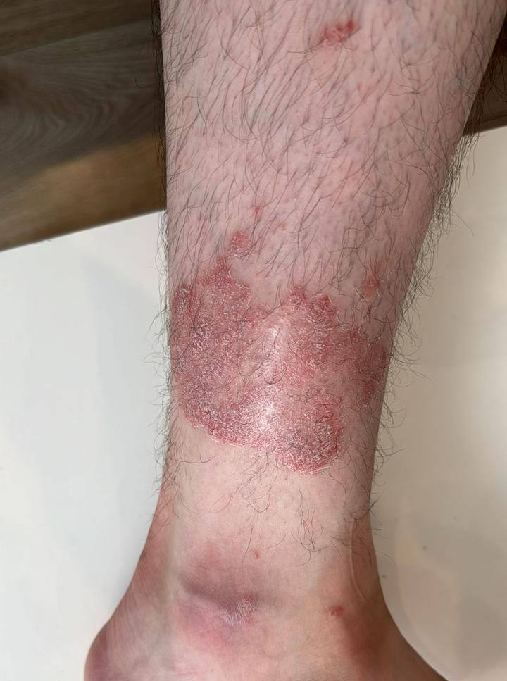 Псориаз голеностопного сустава до лечения — воспаление и бляшки