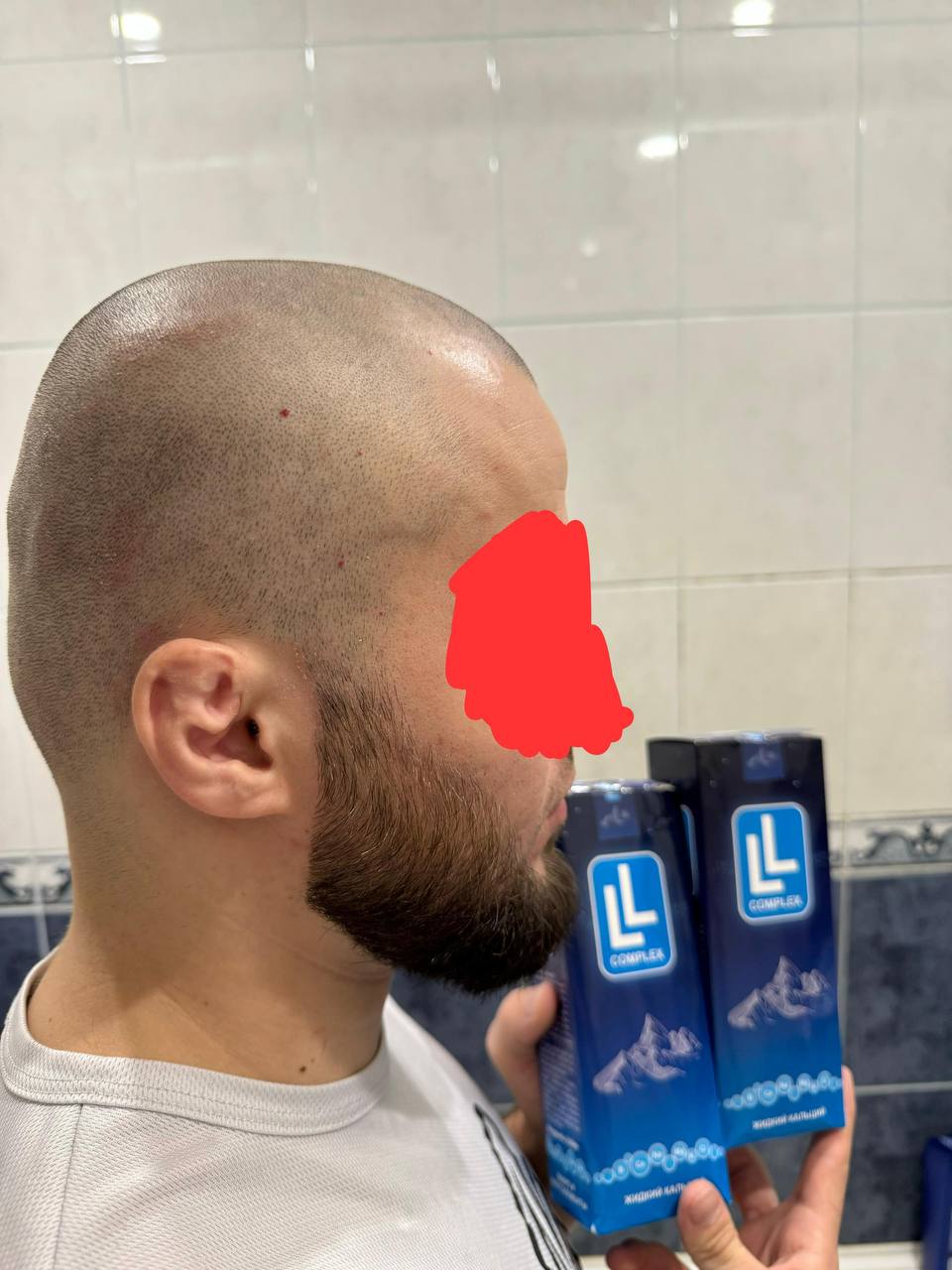 Псориаз волосистой части головы после лечения LL COMPLEX — чистая здоровая кожа