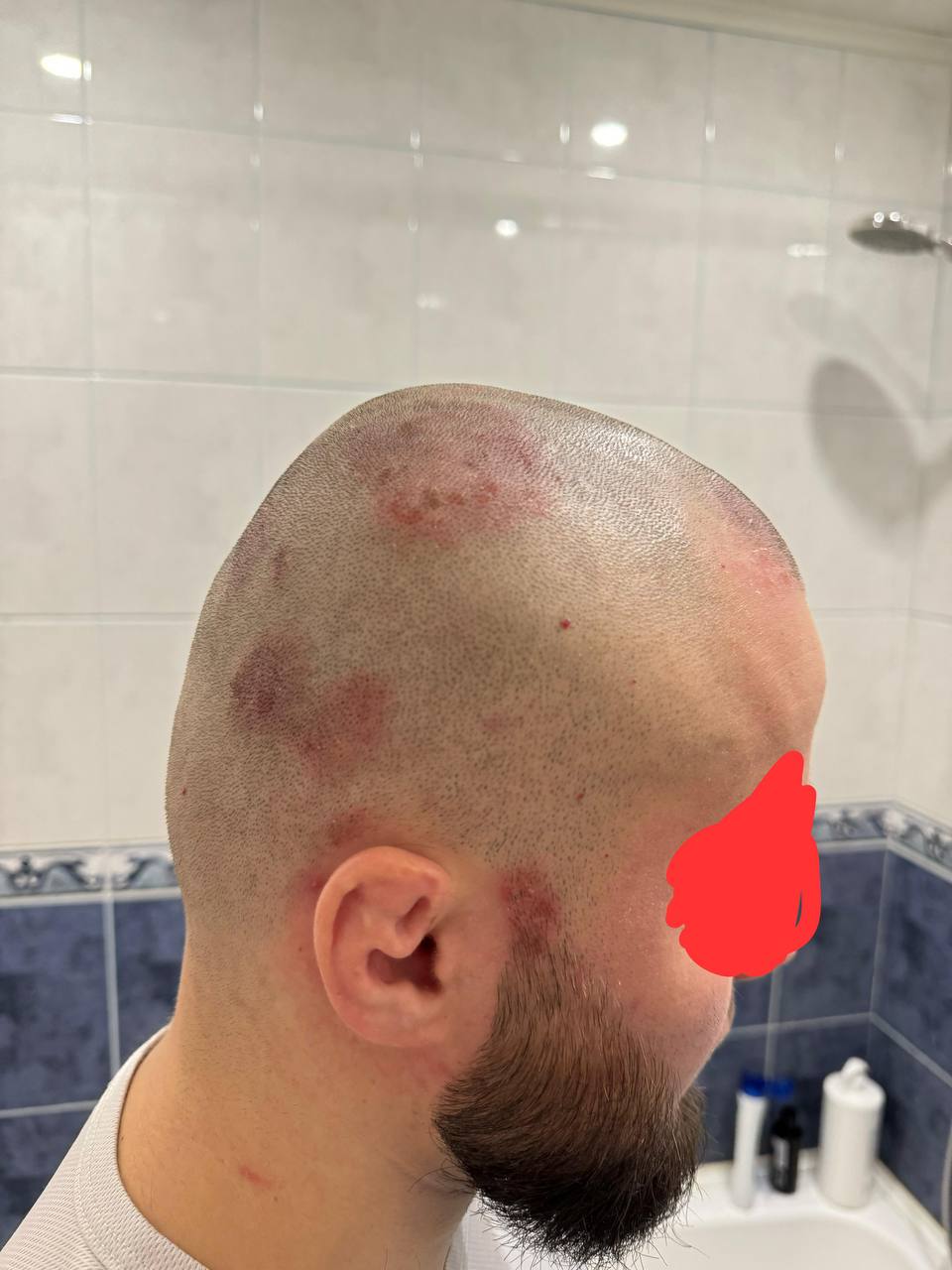 Псориаз волосистой части головы до лечения — выраженные бляшки и шелушение