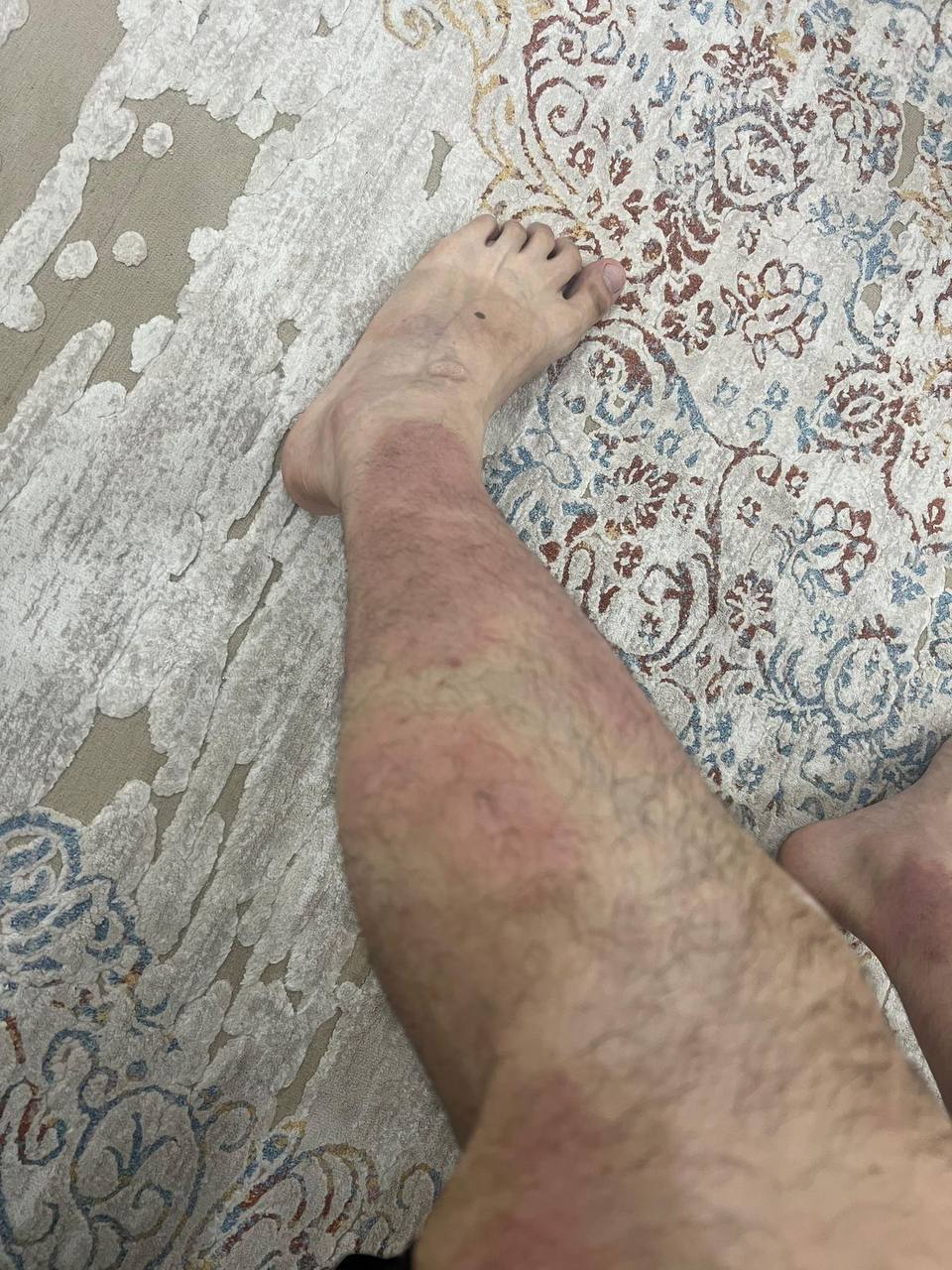 Псориаз ноги после лечения LL COMPLEX — чистая кожа