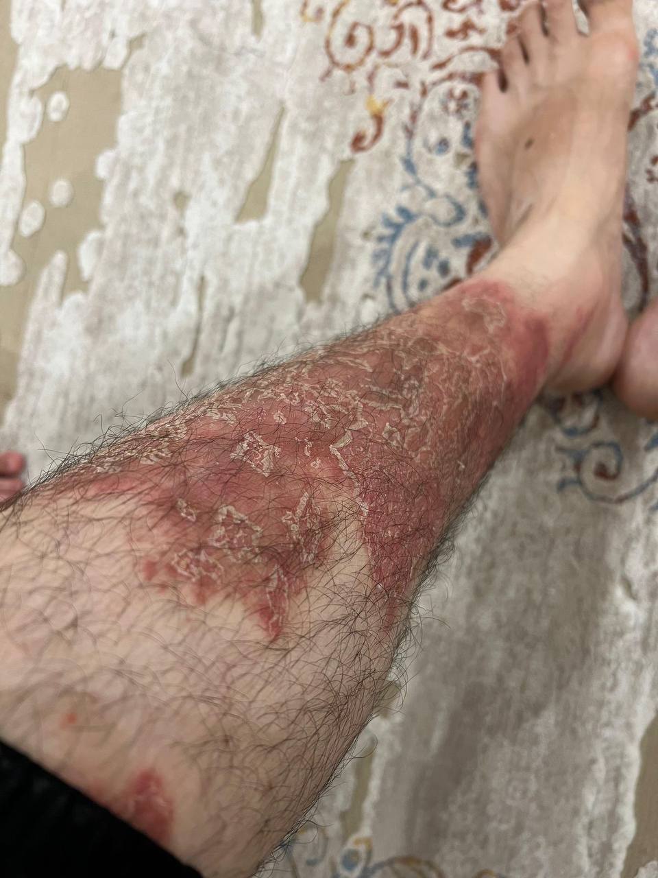 Псориаз ноги до лечения — обширные бляшки