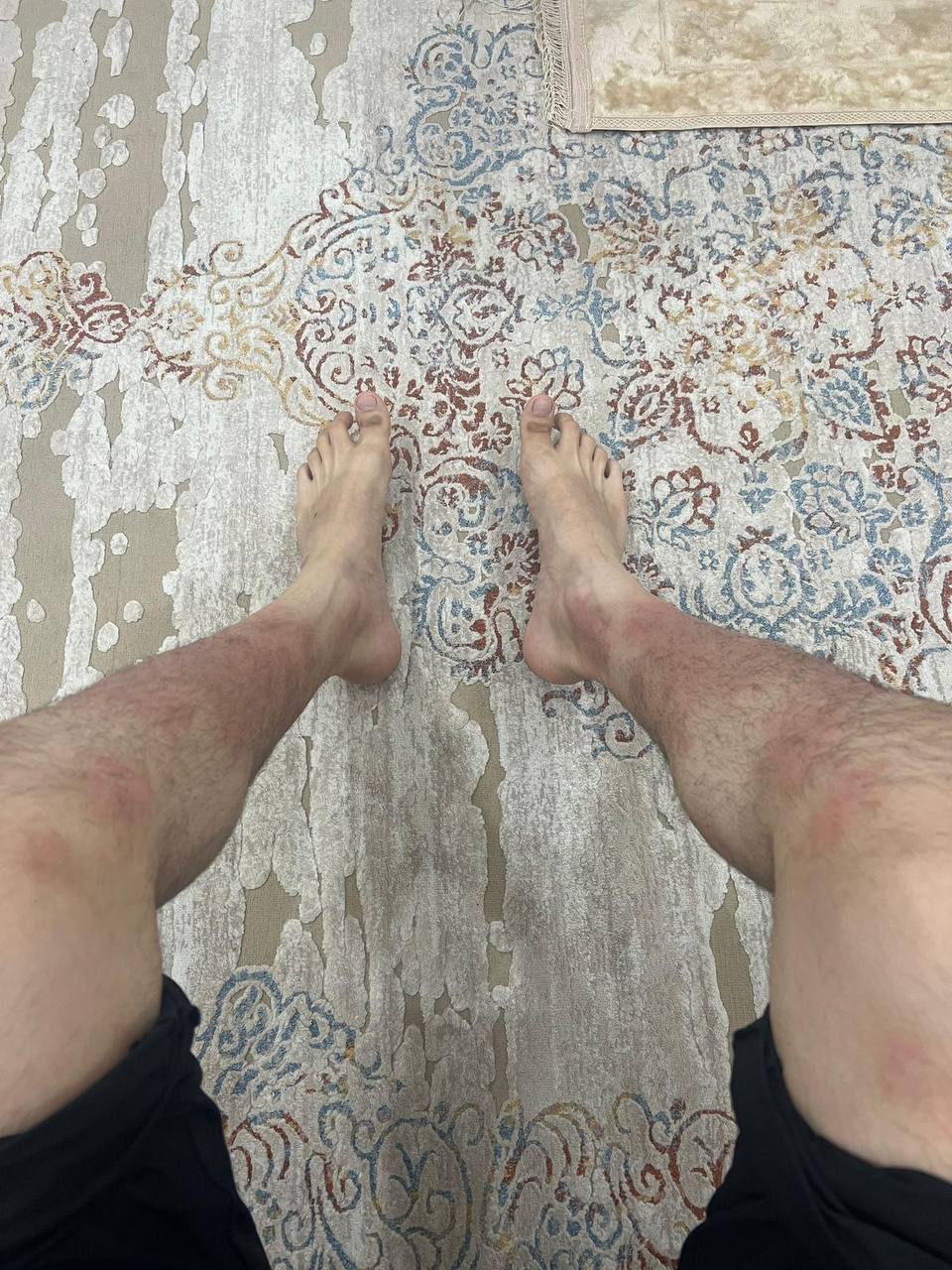 Псориаз нижних конечностей после лечения LL COMPLEX — значительное заживление