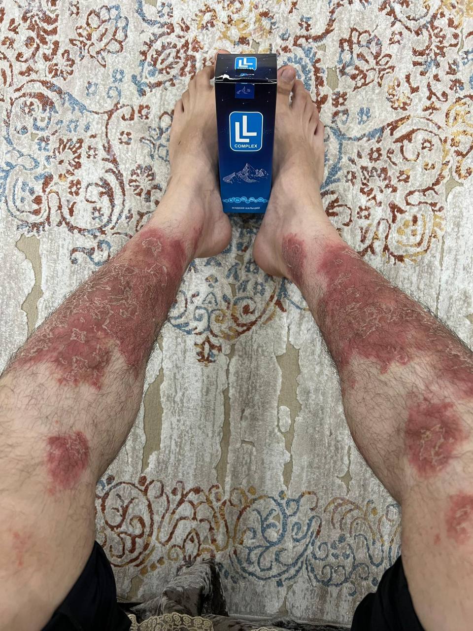 Псориаз нижних конечностей до лечения — крупные бляшки на голенях