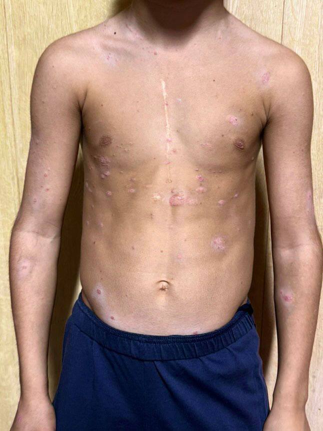 Псориаз туловища до лечения — сухие воспаленные участки кожи